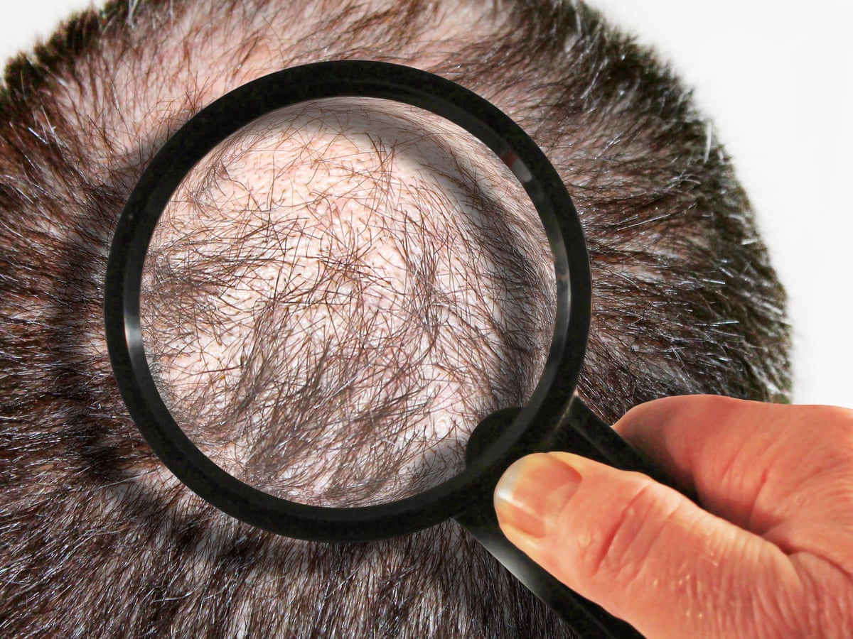 My hair transplant left me emotionally and financially broken' | Consumer  affairs | The Guardian