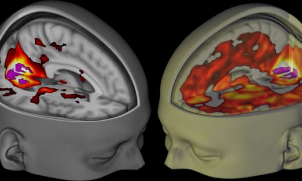 3D fMRI image of the brain