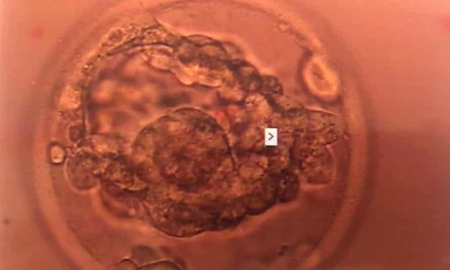 Here she comes: a picture of the chosen embryo before it was implanted
