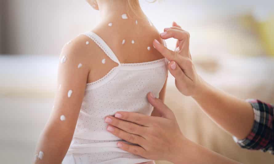 Female hands applying cream on little girl with chicken pox at home