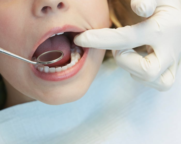 Water fluoridation cut tooth decay in Queensland children, study shows, but most councils have decided against it