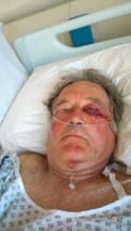 A man with bruising and injury to his face lies in a hospital bed. 