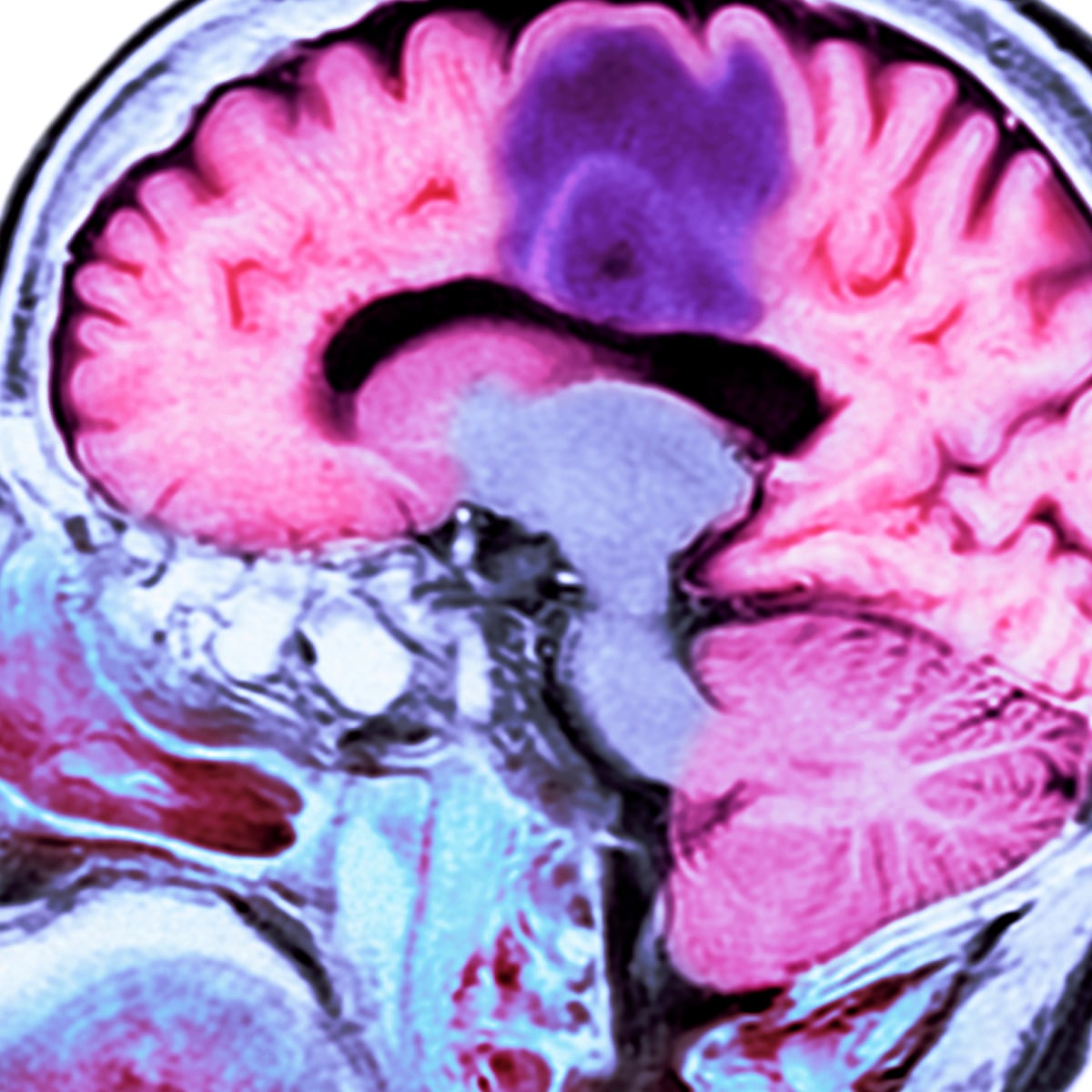 How Long Can A Dog With Brain Tumor Live how-long-can-a-dog-with-brain-tumor-live