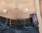 NHS rollout of artificial pancreas narrows inequality in diabetes care