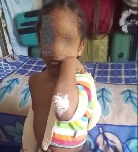 Cream can be seen on the elbow of a small boy whose face is obscured