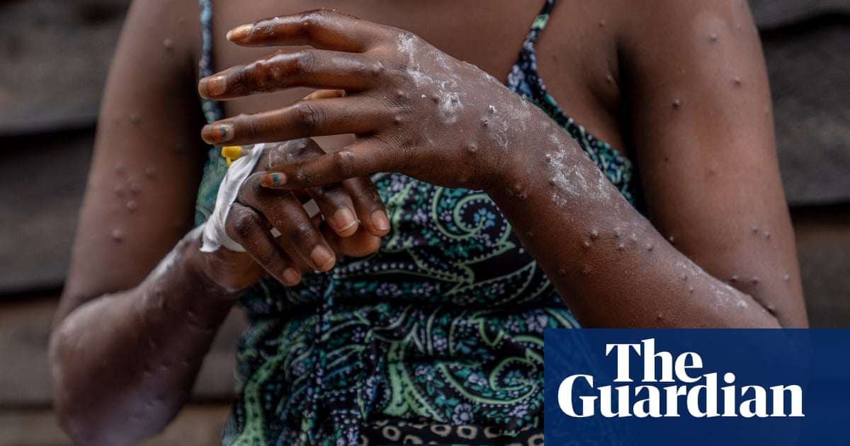 Malawi battles mpox as cases of the infectious disease surge in Africa