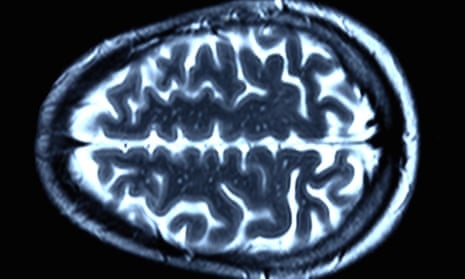 An MRI scan of a healthy brain. In Huntington’s patients, a genetic mutation causes irreversible damage to the brain.