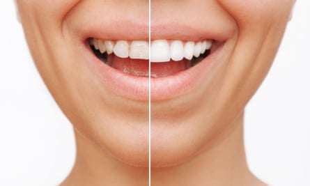 Before and after shots of tooth veneers.