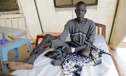 A young man in South Sudan had his left leg amputated after a severe infection caused by snakebite.
