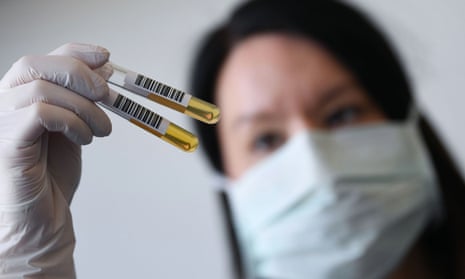 A researcher holds vials of plasma at the University Hospital Erlangen, Germany