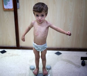 A Syrian toddler is weighed in a medical examination in eastern Ghouta, Damascus.