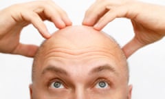 The head of a balding man.