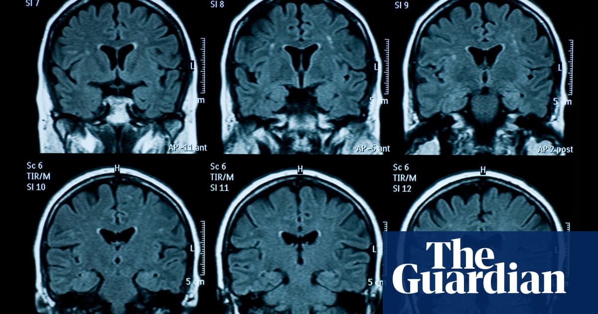 Brains of post-pandemic teens show signs of faster ageing, study finds