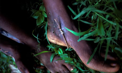A white guinea worm is wound around a stick as it is extracted from a patient's foot.