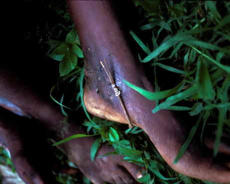 Can we eradicate a second human disease? – podcast