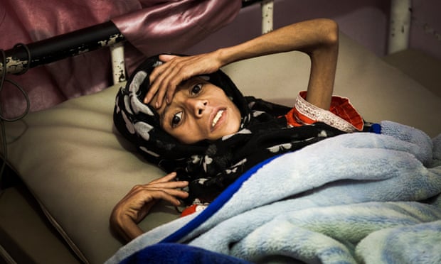 Eleven-year-old Sadia Ibrahim Mahmud, who has since died, in a bed at the malnutrition ward of the al-Sabeen Women and Children’s Hospital in Sana’a, on 12 September, 2019