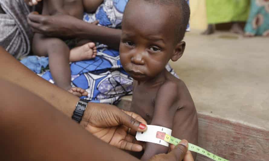 A doctor checks a malnourished child at a camp in Yola.