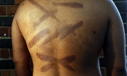 A man shows scars on his back that he claims were inflicted by Sri Lankan security forces