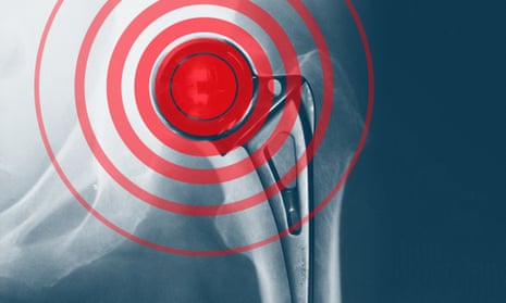 A graphic of a hip replacement