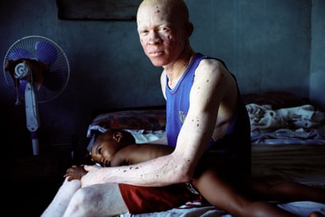 Ibrahim Issa Choela, 29, and his two-year-old daughter, Jueria (2yrs) in Dar es Salaam, Tanzania. Choela has had to move house because of threats and attacks due to the illegal market in albino body parts.
