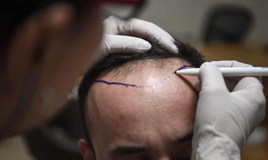 A hair transplant specialist prepares a patient.