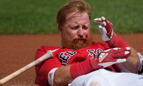 Red Sox’ Justin Turner taken to hospital after being hit in face by pitch