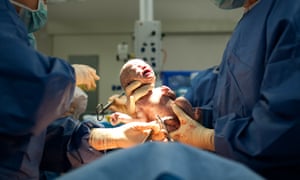 Baby being born via caesarean section.