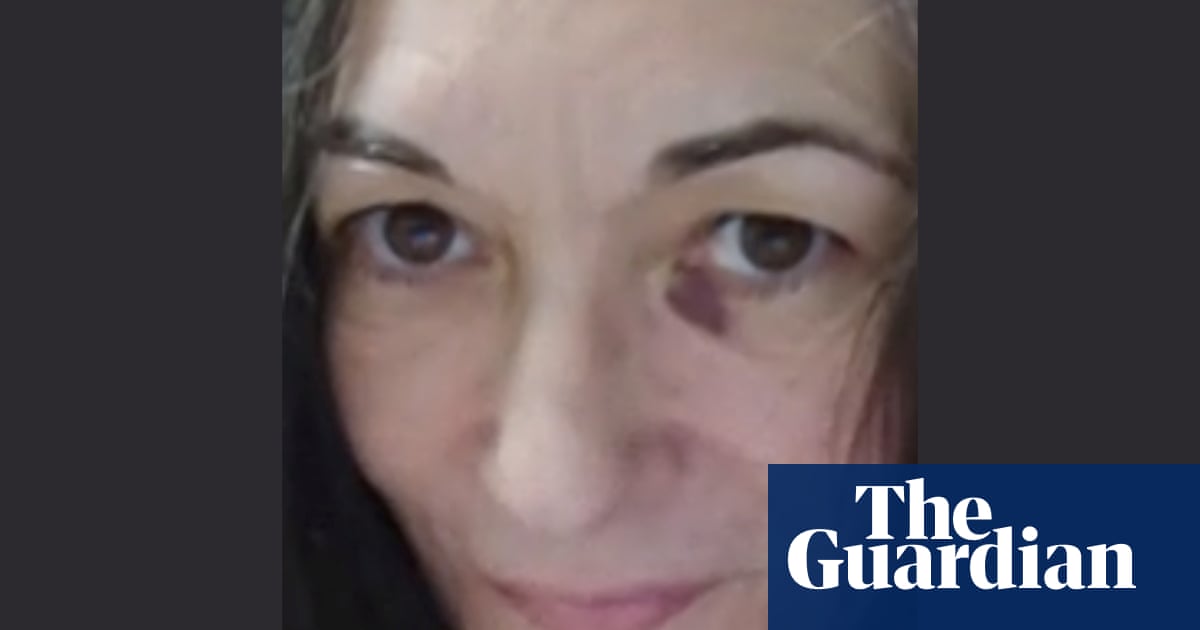 Ghislaine Maxwell: lawyers release photo showing bruised face