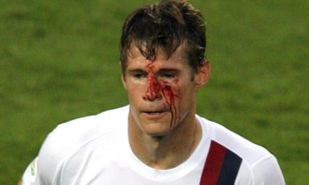 Brian McBride's bloody face became the iconic image of the 2006 USA campaign