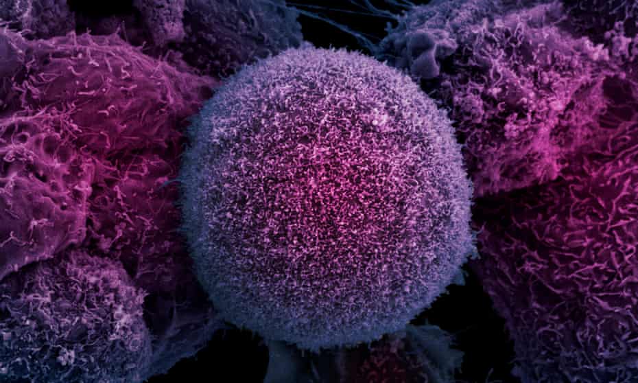 Electron microscope image of prostate cancer cells.
