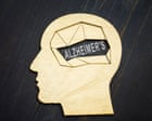 Alzheimer’s trial to test drug on people without symptoms to see if it can be prevented