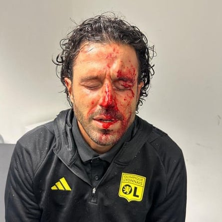 Fabio Grosso with his face covered in blood