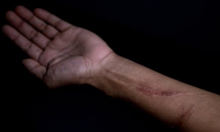Aung Tun’s left forearm with a long scar on the inside