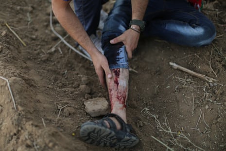 A person shows their bloodied leg