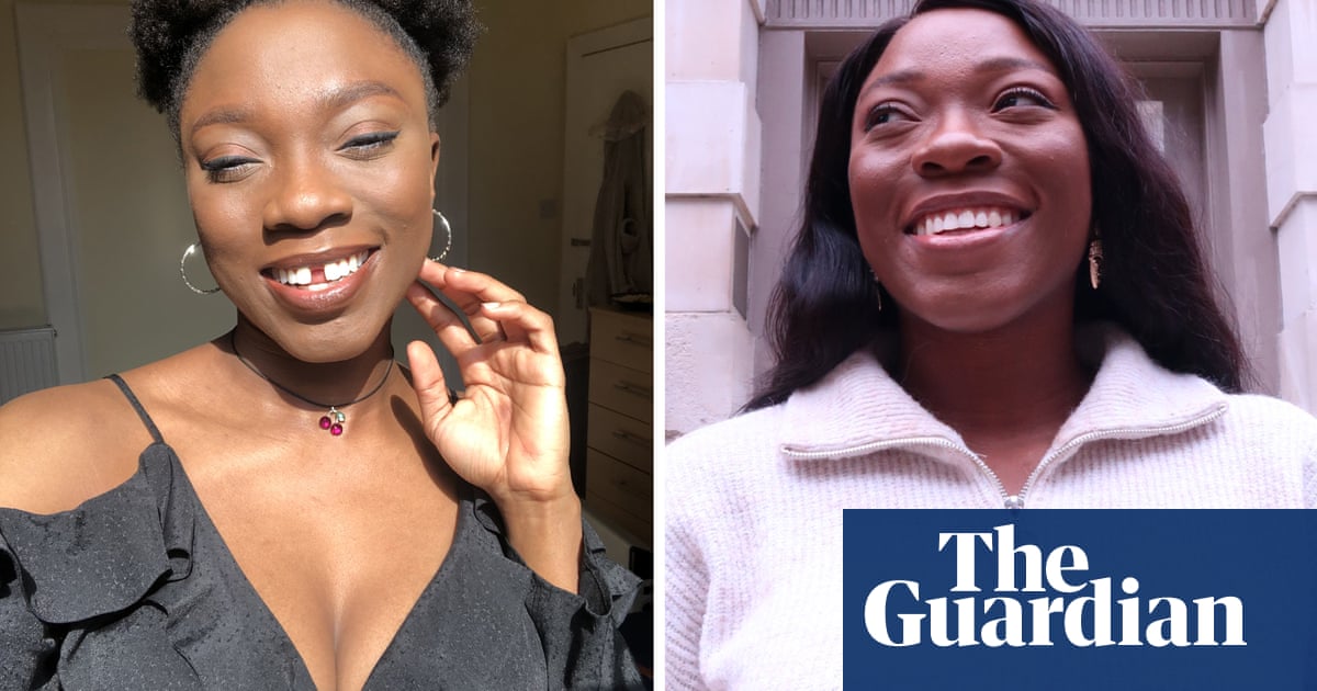‘I can’t imagine getting married with those teeth’: how Britain fell for adult braces