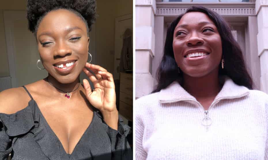 Dabi Adesoye, before and after teeth aligner treatment