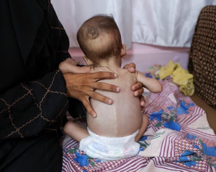 Rear view of undernourished baby