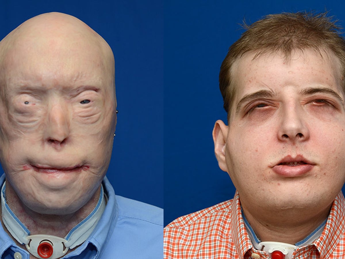 Firefighter receives full face transplant in surgery called 'historic' | US news | The Guardian