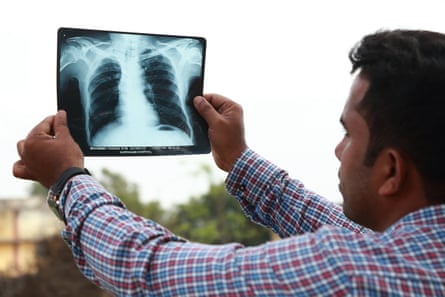 Saludeen Younus with his father’s X-ray. Doctors told the family that asbestos dust had clogged his lungs.