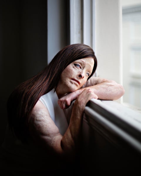 A burn survivor sits at a window