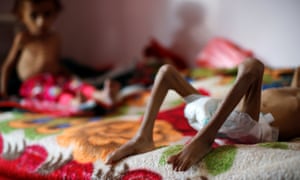Malnourished boys in a malnutrition treatment centre in Sanaâa, Yemen