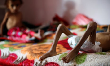 Malnourished boys in a malnutrition treatment centre in Sana’a, Yemen