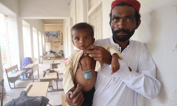 Zeeshan Chandio with his son Nadeem, whose stomach has swollen.