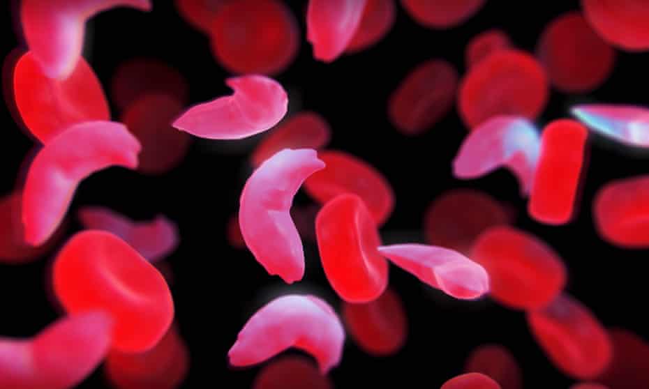 Sickle cell disease is a recessive genetic blood disorder characterised by red blood cells that assume an abnormal, rigid, sickle shape.
