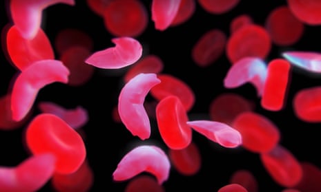 Healthy blood cells are seen along with diseased cells. About 300,000 babies are born with the disease each year.