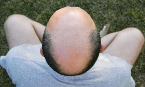 Balding man's head