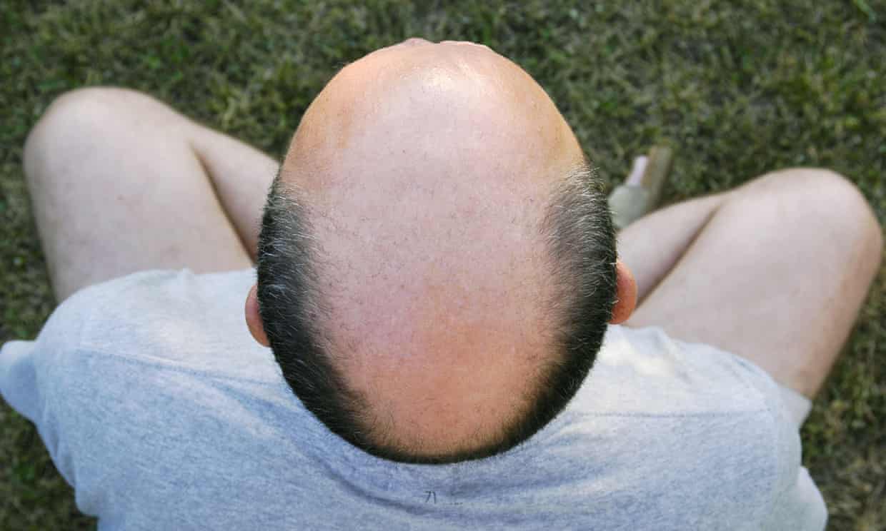 https://www.theguardian.com/world/2022/may/13/calling-a-man-bald-is-sexual-harassment-employment-tribunal-rules