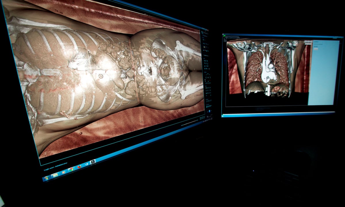 Digital autopsies should be standard for probable natural deaths