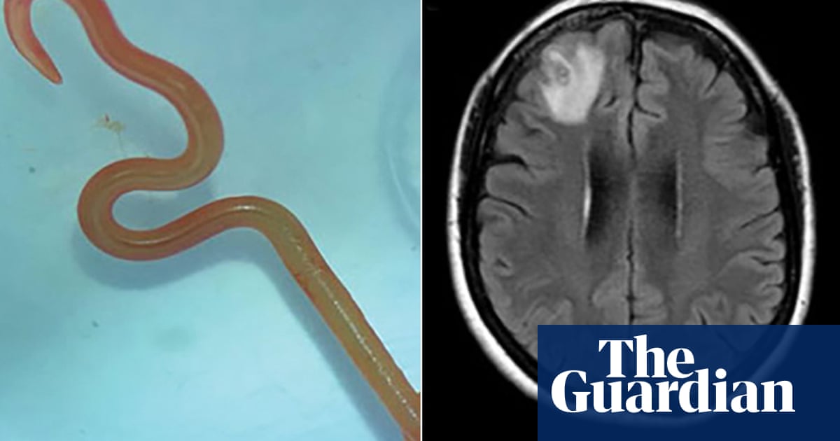 ‘Oh my god’: live worm found in Australian woman’s brain in world-first discovery