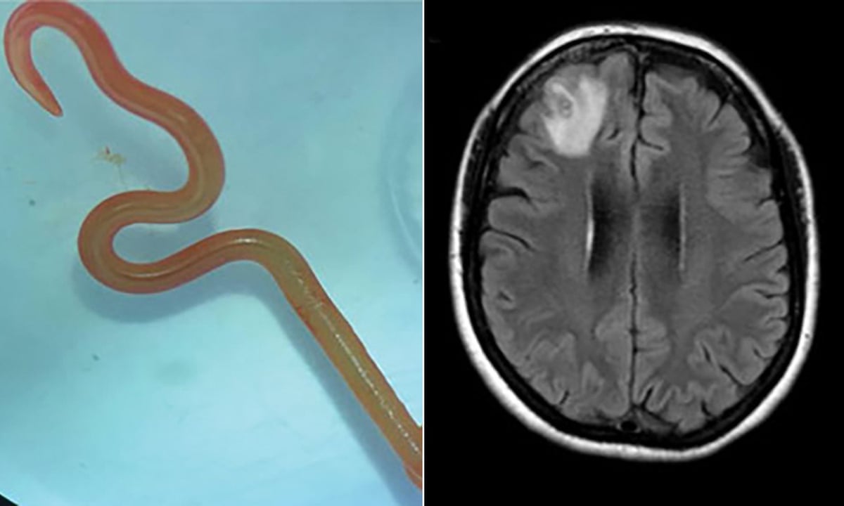 Oh my god': live worm found in Australian woman's brain in world